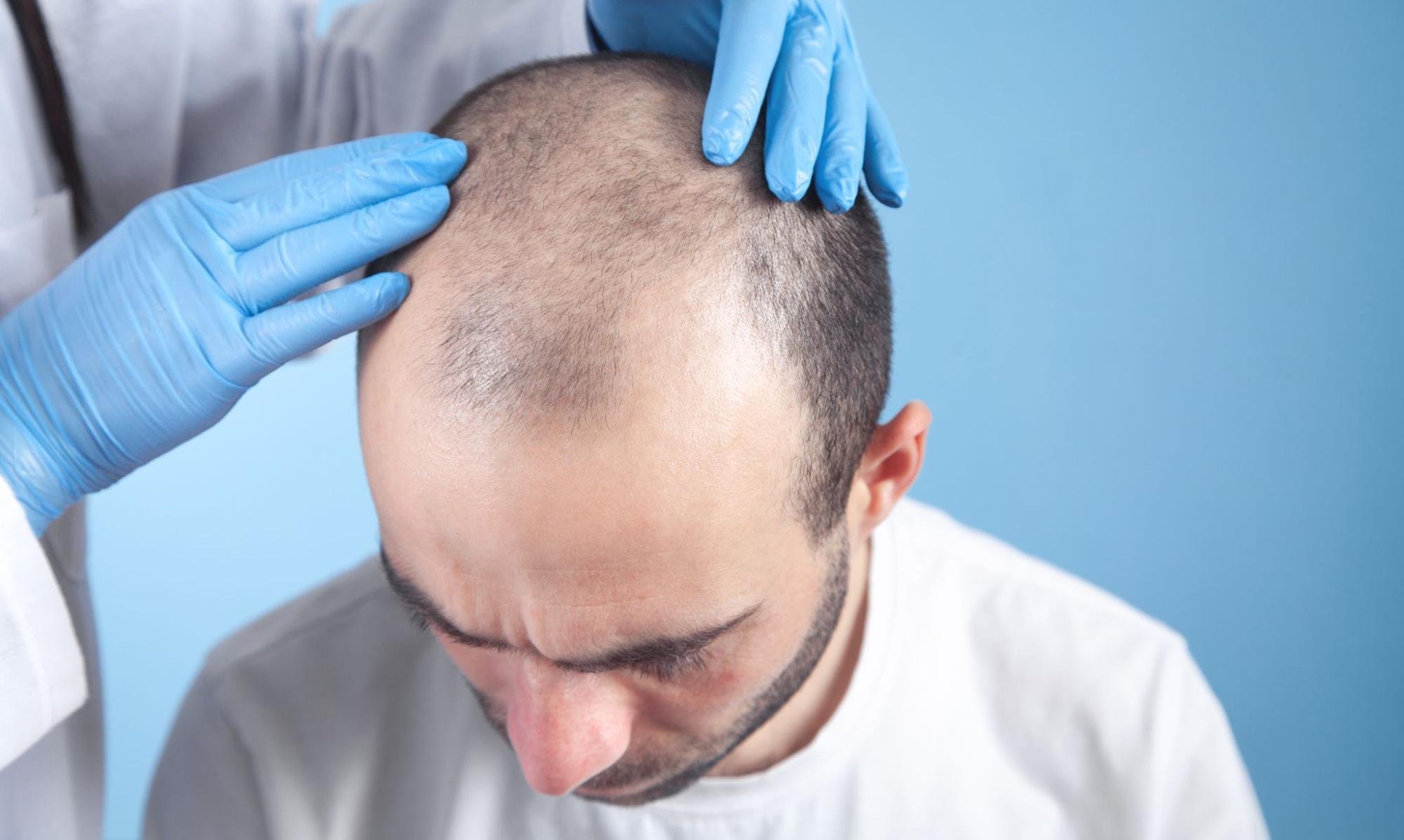 All About ARTAS Robotic Hair Restoration