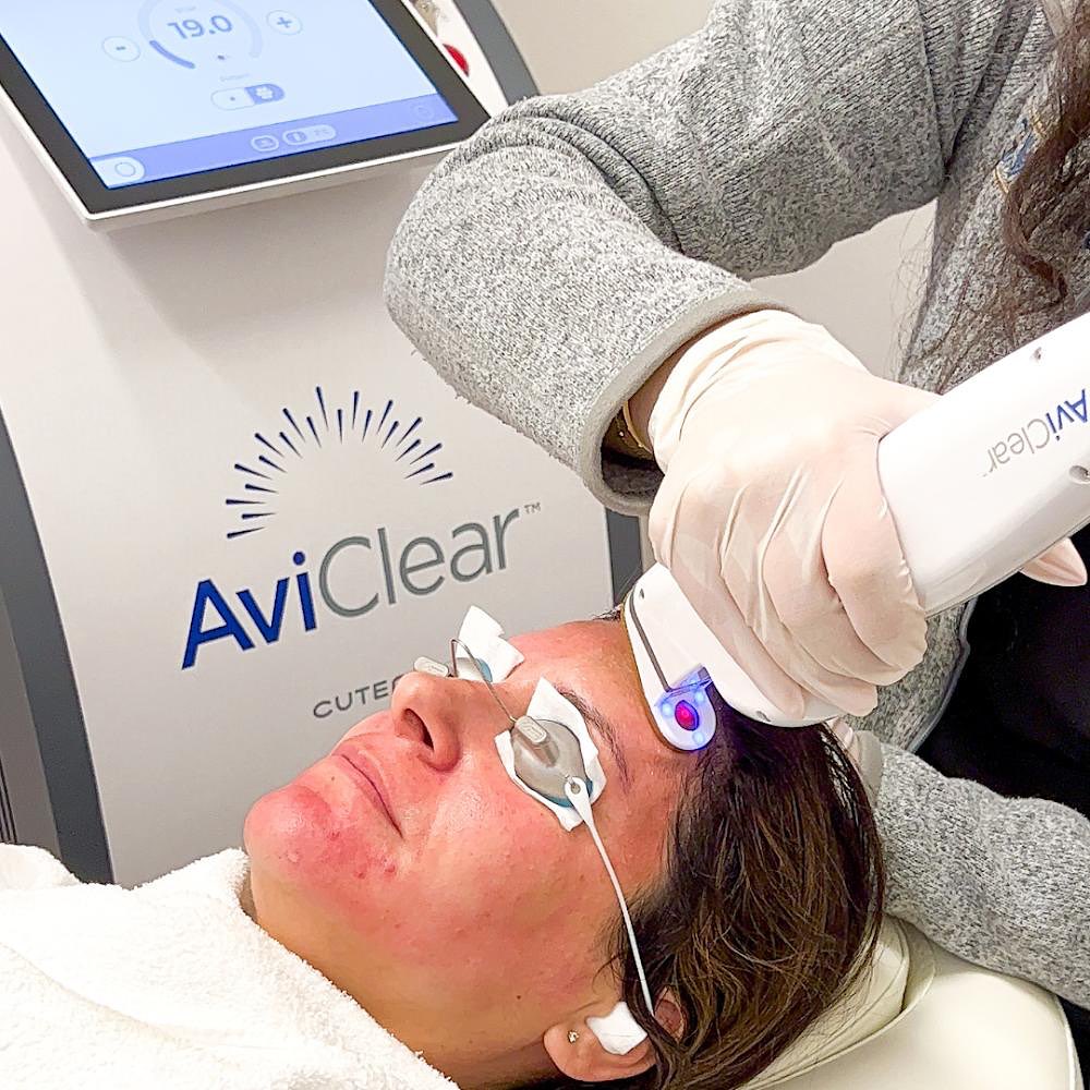 AviClear: A Breakthrough in Acne Treatment