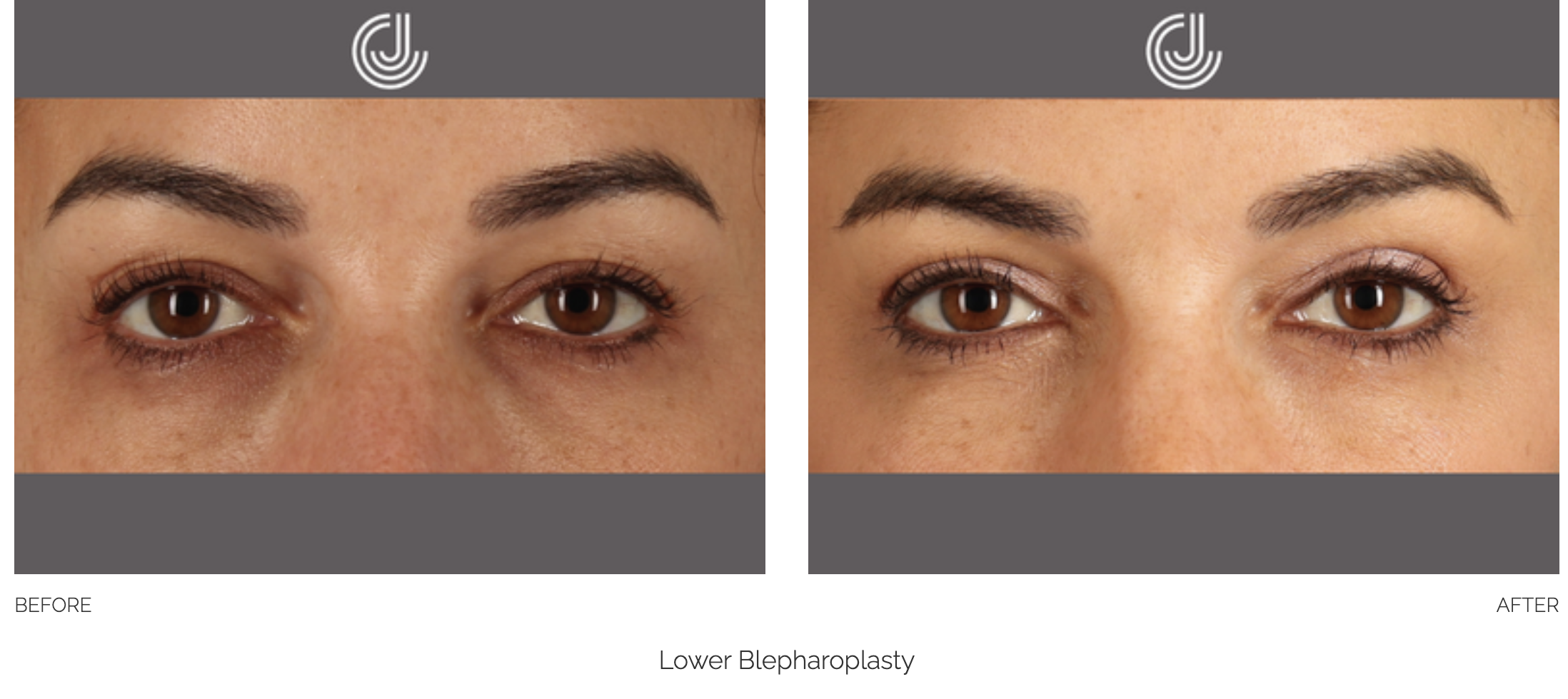 blepharoplasty-11
