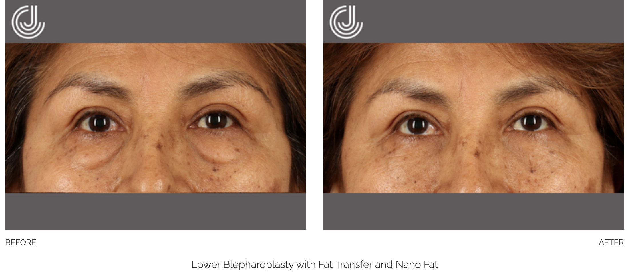 blepharoplasty-15