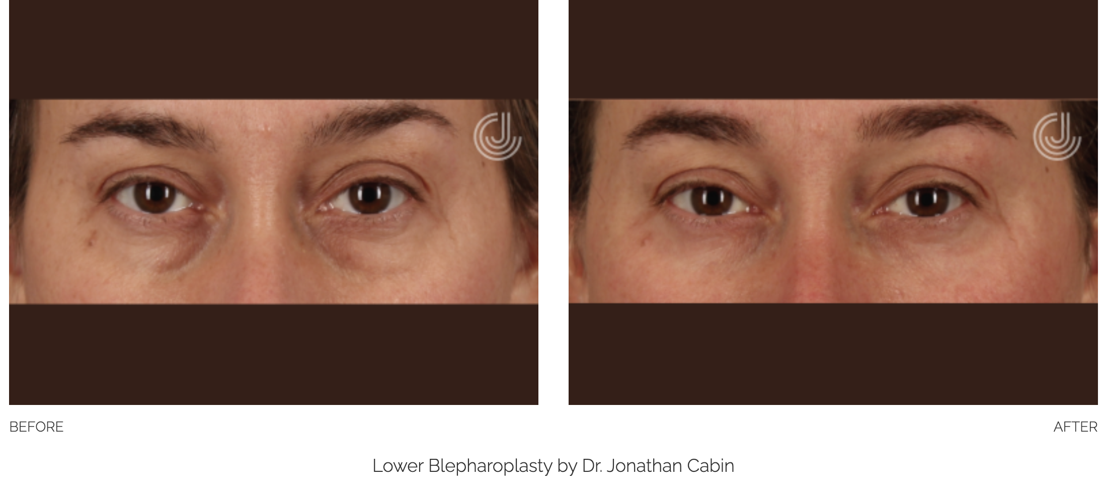 blepharoplasty-19
