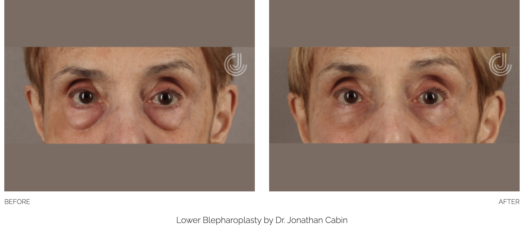 blepharoplasty-22