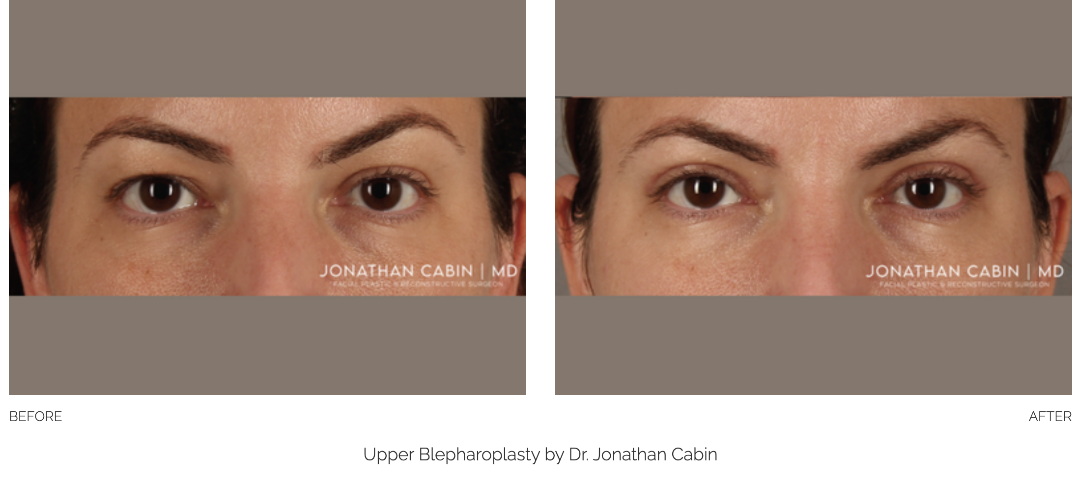 blepharoplasty-26