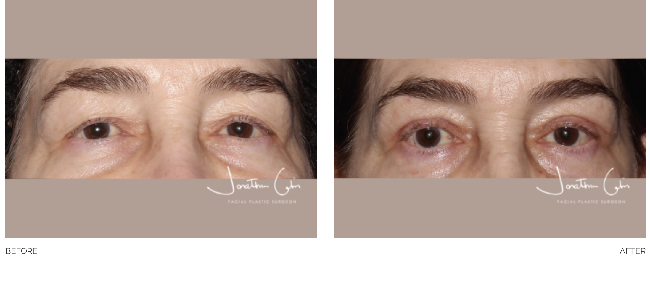 blepharoplasty-30