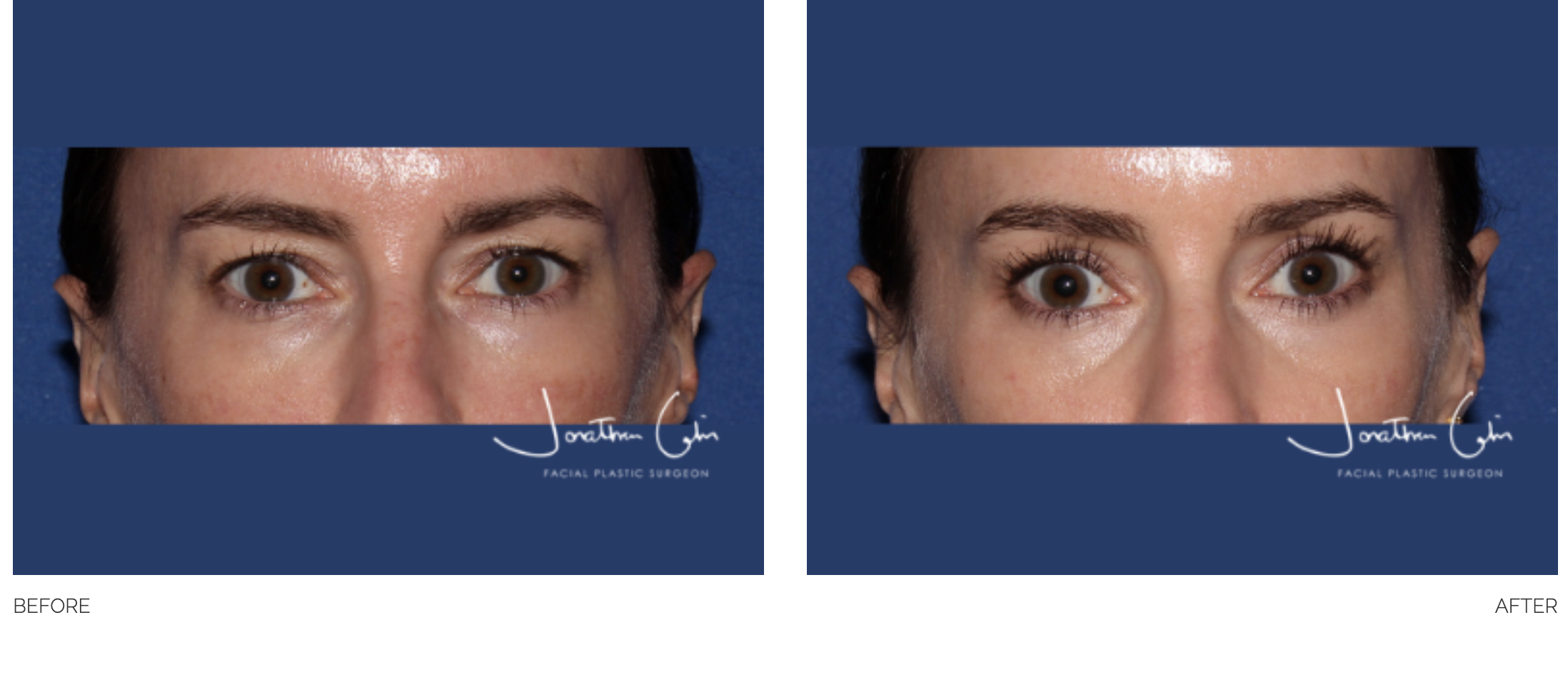 blepharoplasty-33