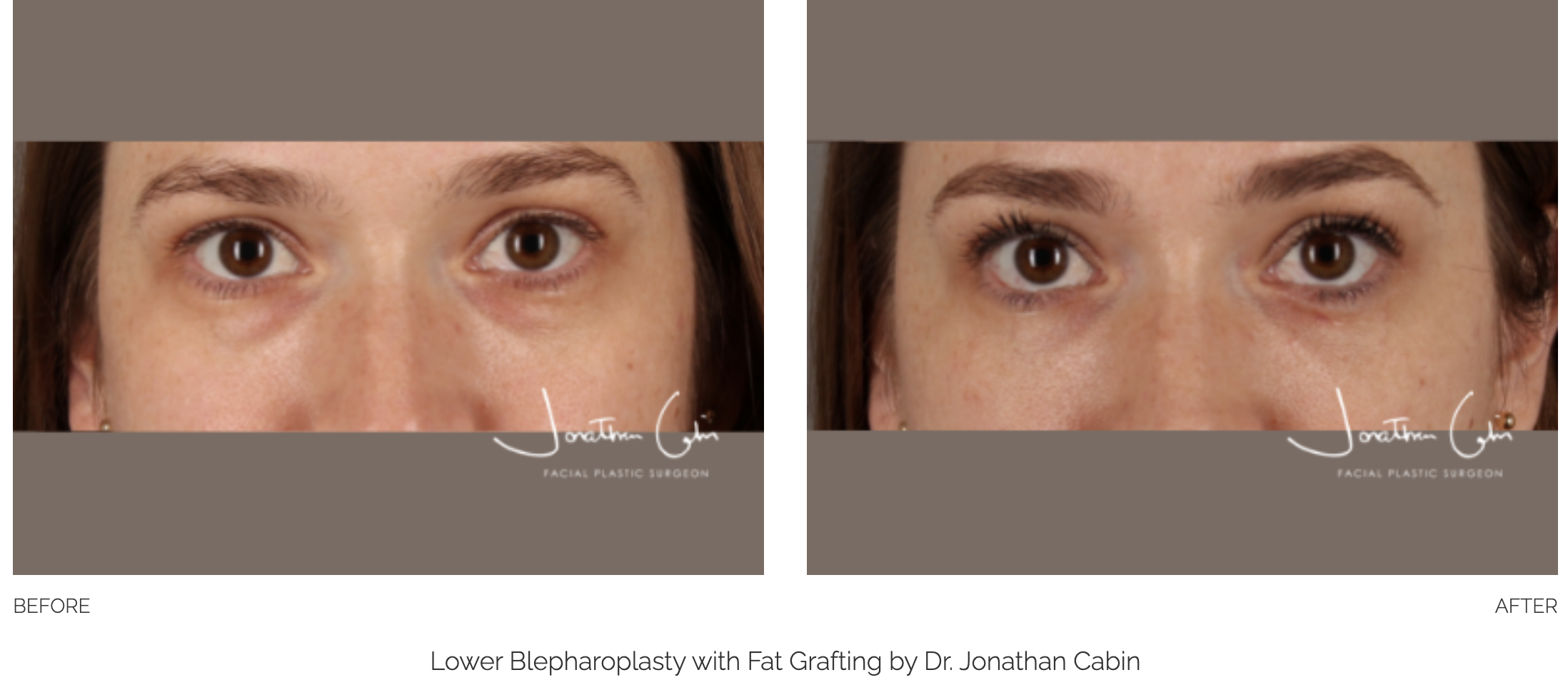 blepharoplasty-35