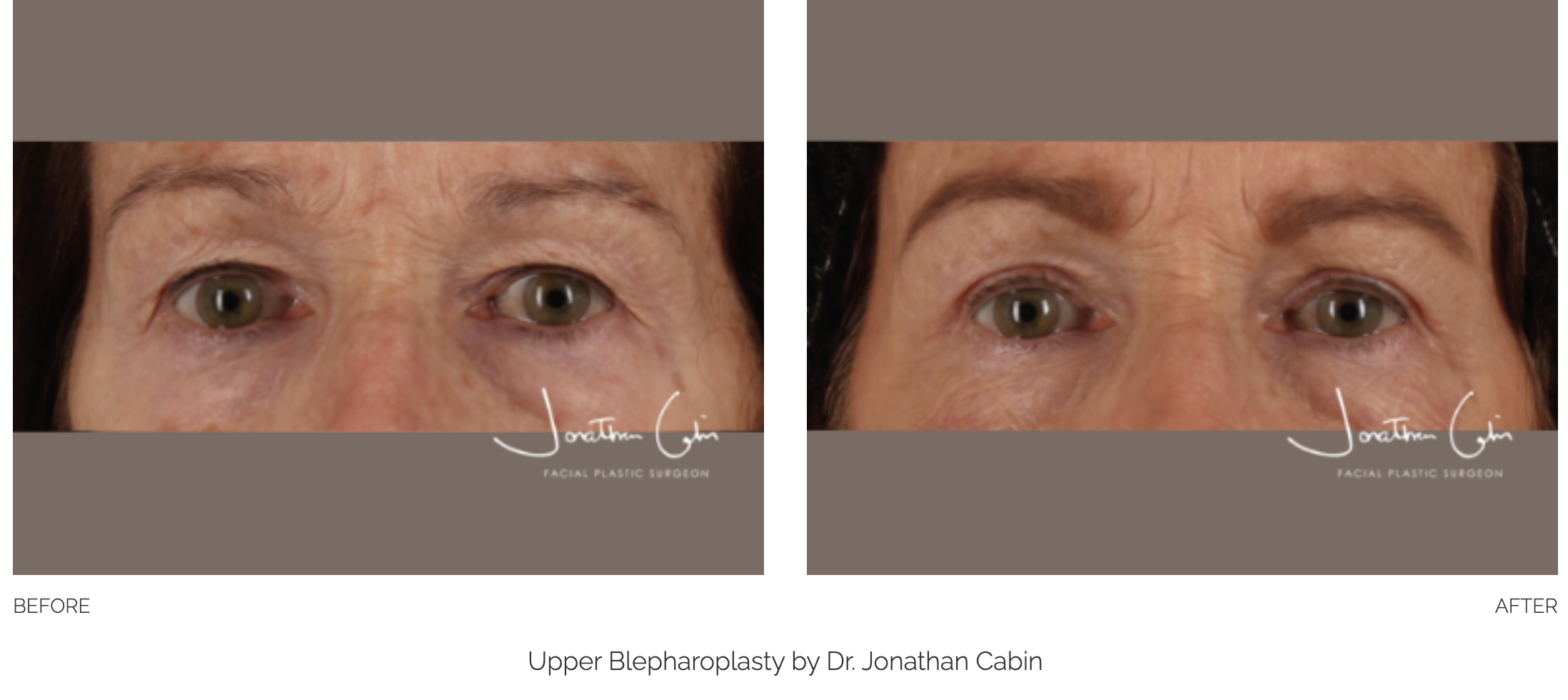 Blepharoplasty Gallery