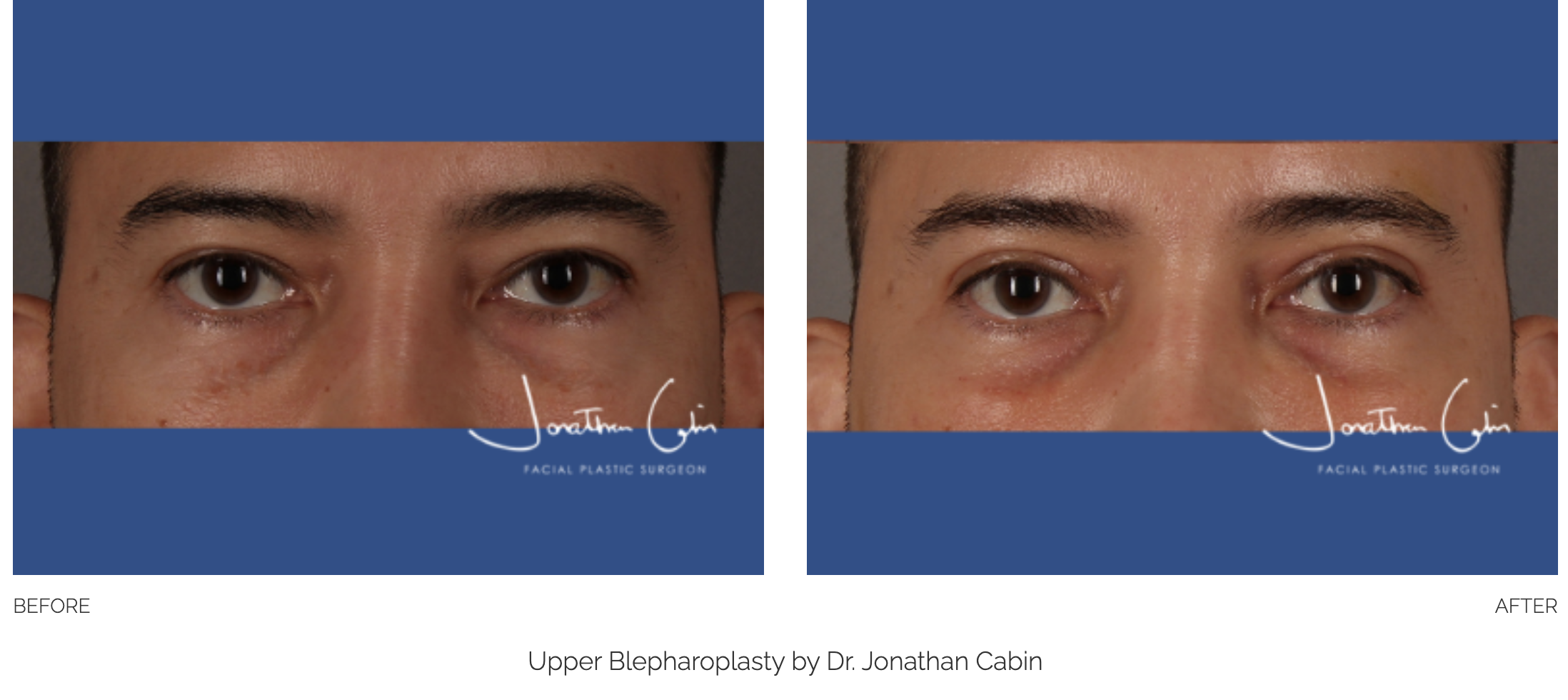 blepharoplasty-40
