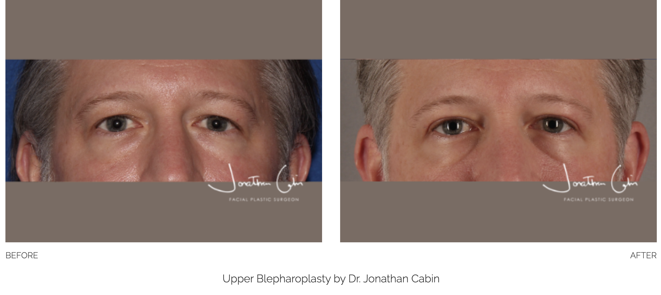 blepharoplasty-44