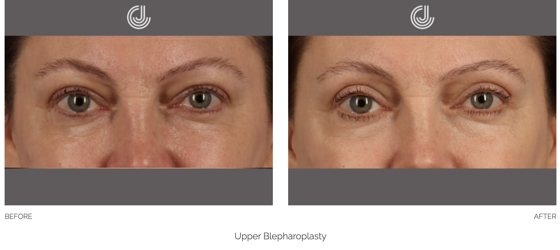 blepharoplasty-5