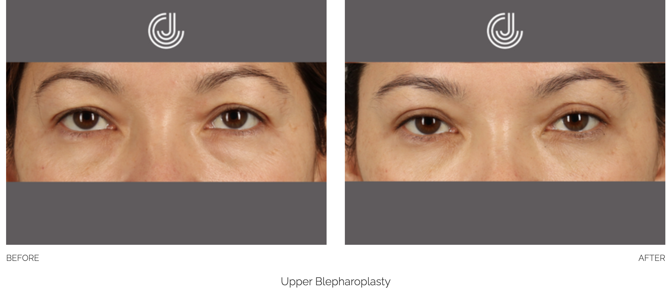 blepharoplasty-9