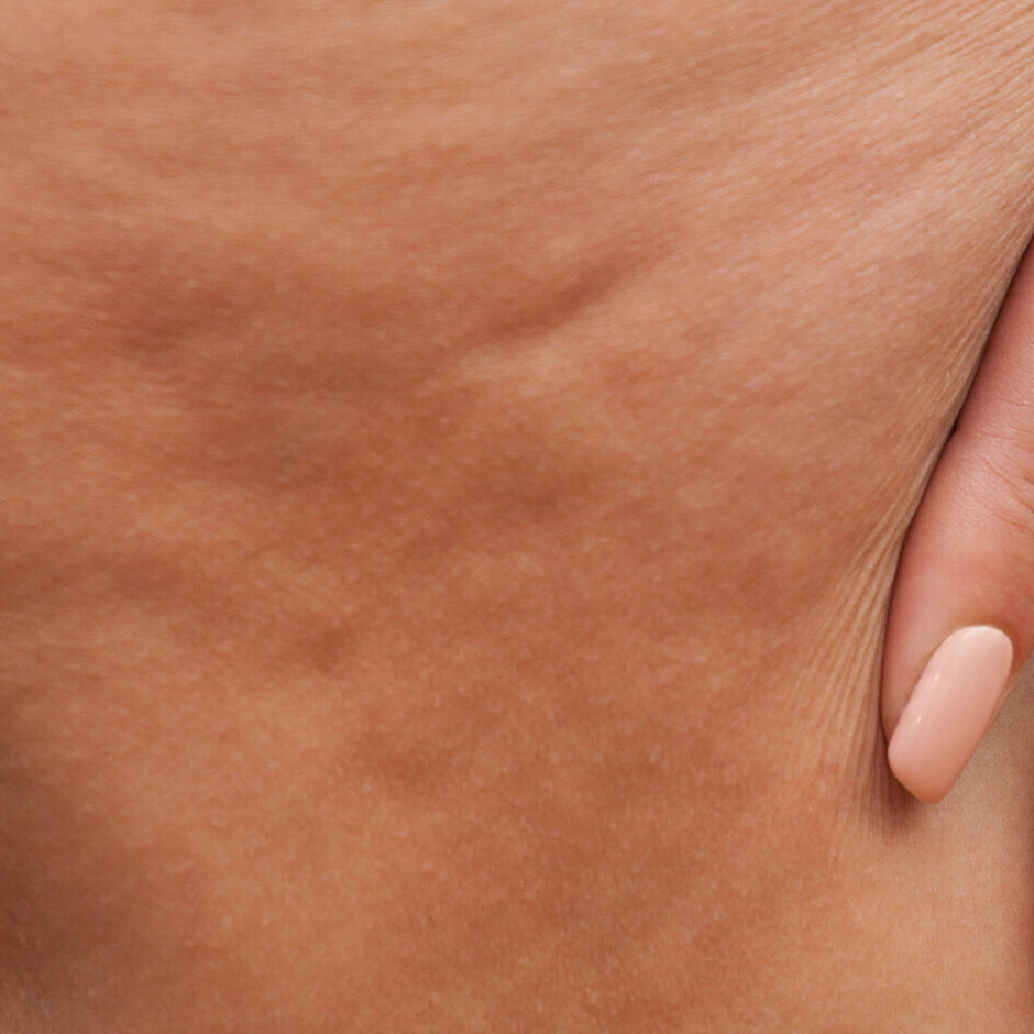 Girl shows holding and pushing the skin of the legs cellulite, orange peel. Treatment and disposal of excess weight, the deposition of subcutaneous fat tissue
