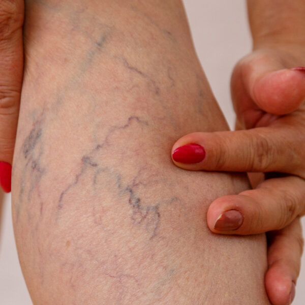 Veins