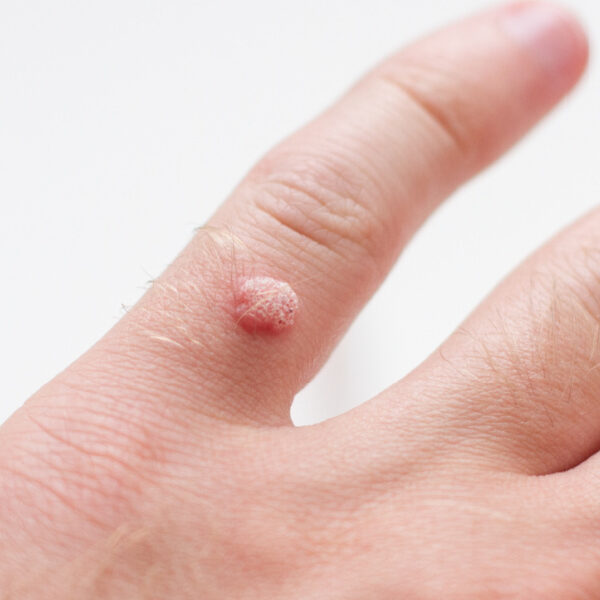 Warts