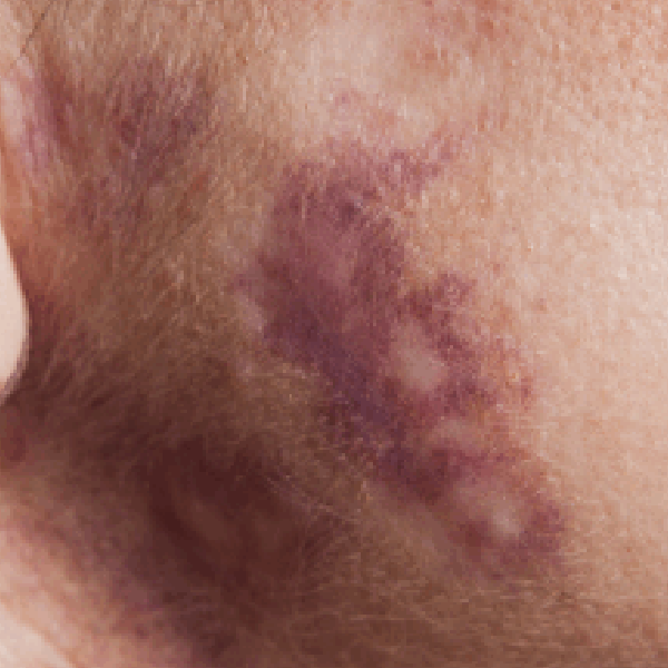 Birthmarks