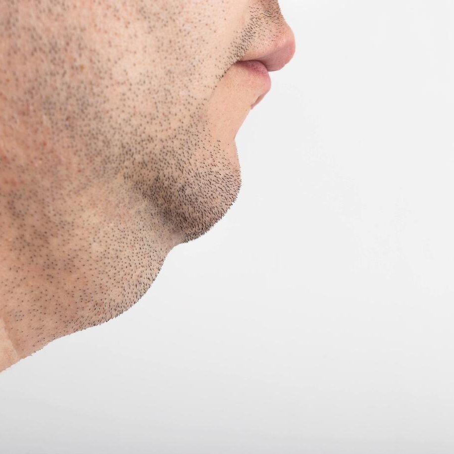 FaceTite Skin Tightening