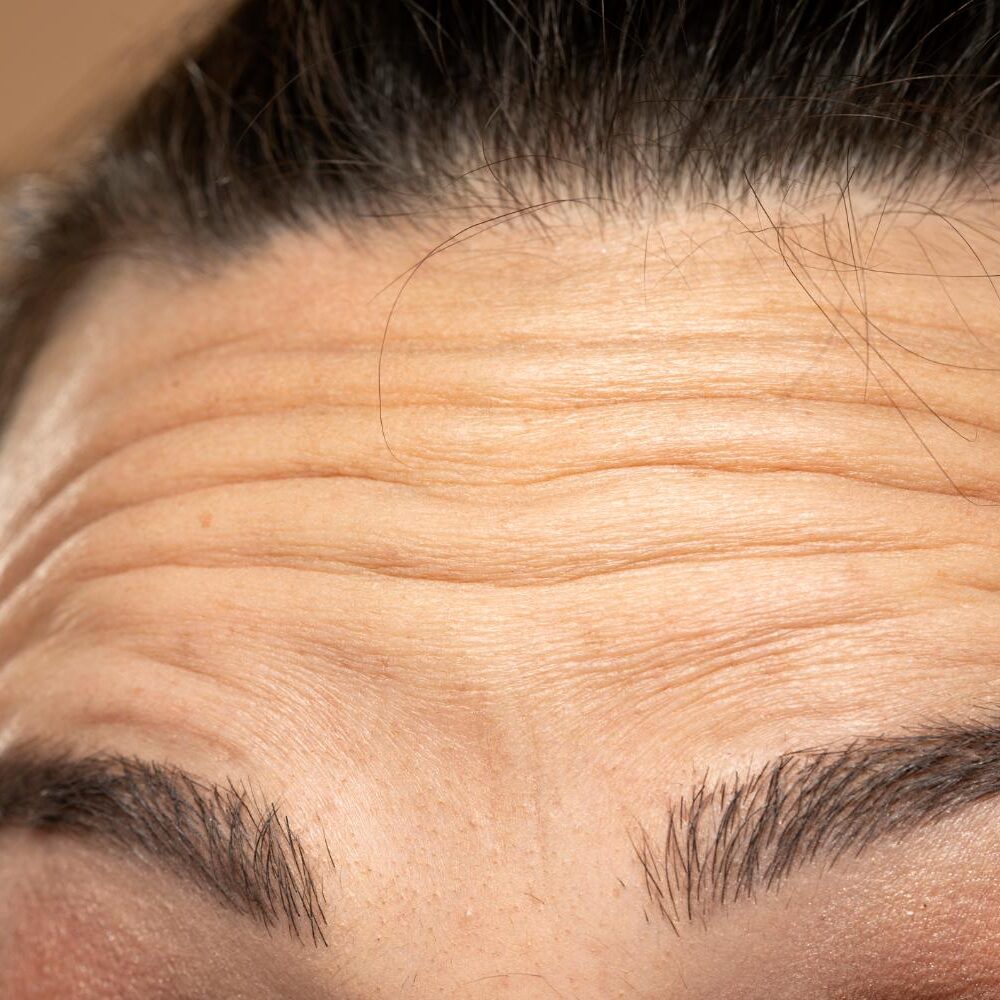 Fine Lines & Wrinkles
