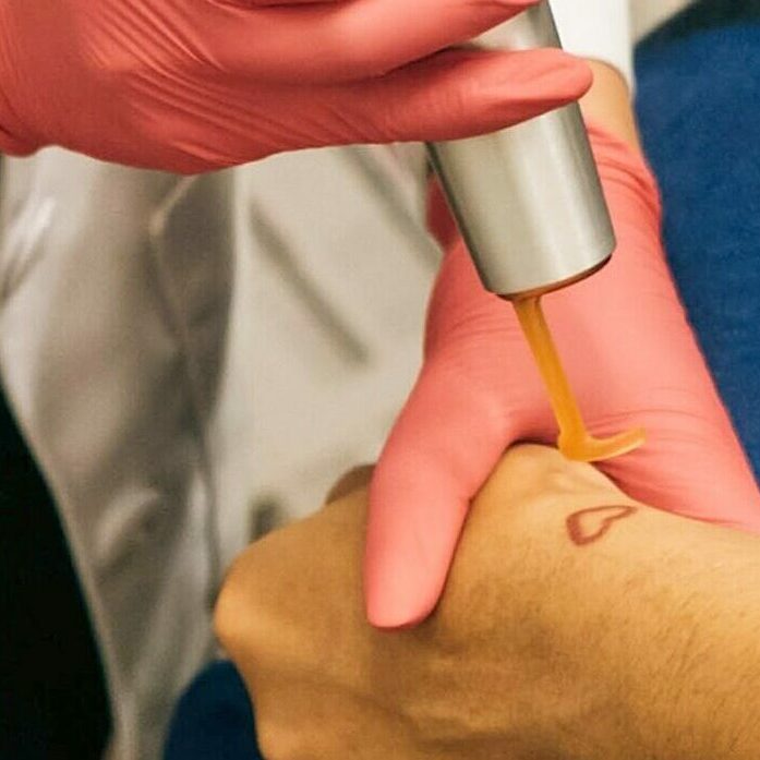 Tattoo removal using laser